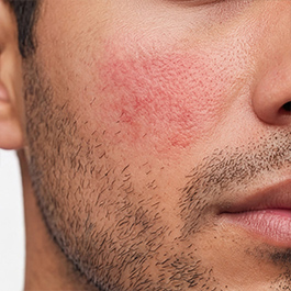 Alantel Crema calmante sin corticoides para el picor e irritación